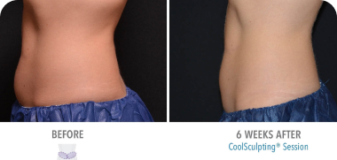 CoolSculpting Patient 6 Marge Image