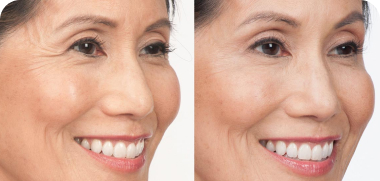 CoolSculpting Patient 5 Featured Image