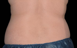 CoolSculpting Patient 3 After Image