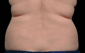 CoolSculpting Patient 3 Before Image