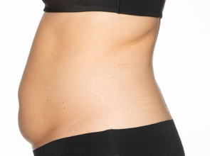 CoolSculpting Patient 4 Before Image