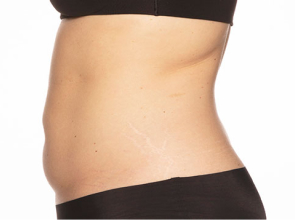 CoolSculpting Patient 4 After Image