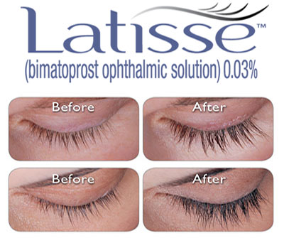 latisse comparison image