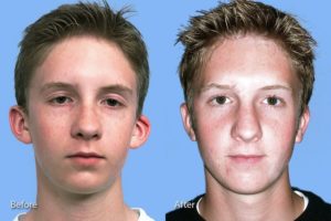 Otoplasty before and after