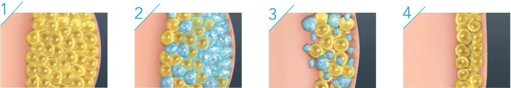 Cryolipolysis Science Diagram - BHRC