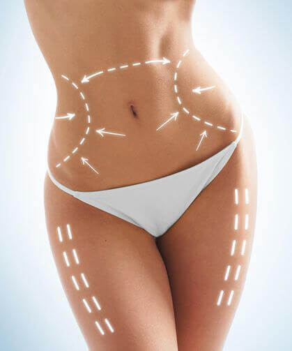 Cryolipolysis on Body - BHRC