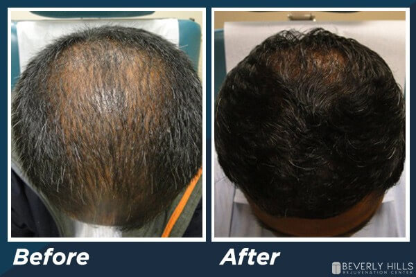 Low Level Laser Therapy Hair Loss B&A 4