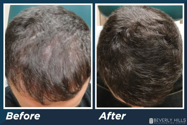 Low Level Laser Therapy Hair Loss B&A 3