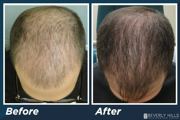 Low Level Laser Therapy Hair Loss B&A 1