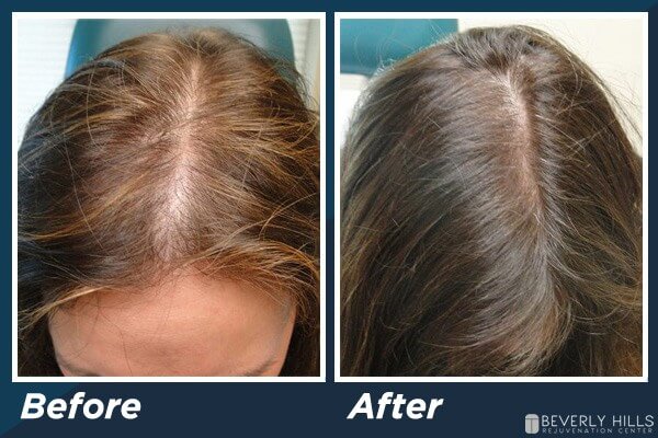 Low Level Laser Therapy Hair Loss B&A 2