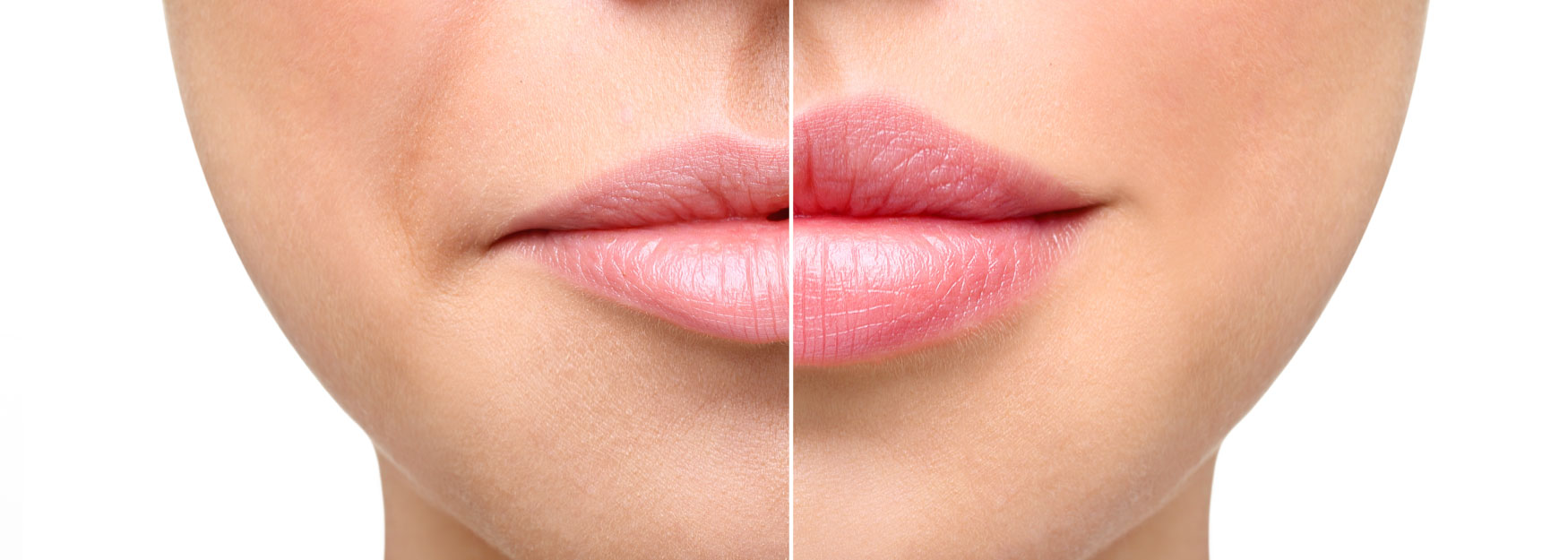 What Are Lip Fillers? Image