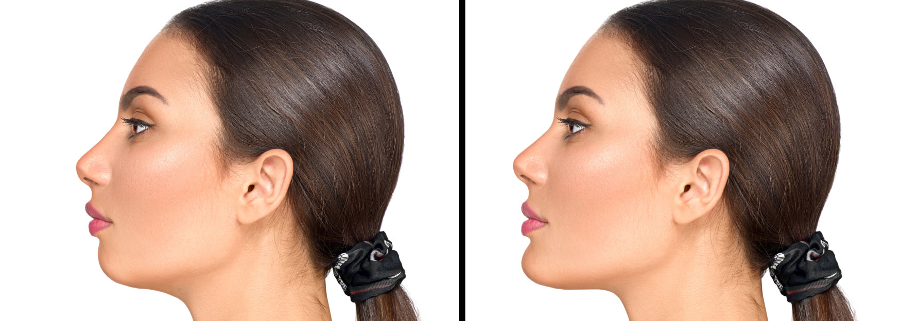 The Most Effective Products for Under Chin Fat Removal Image