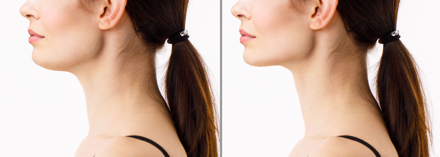 How to Get Rid Of Chin Fat: The Latest Technology Revealed Image