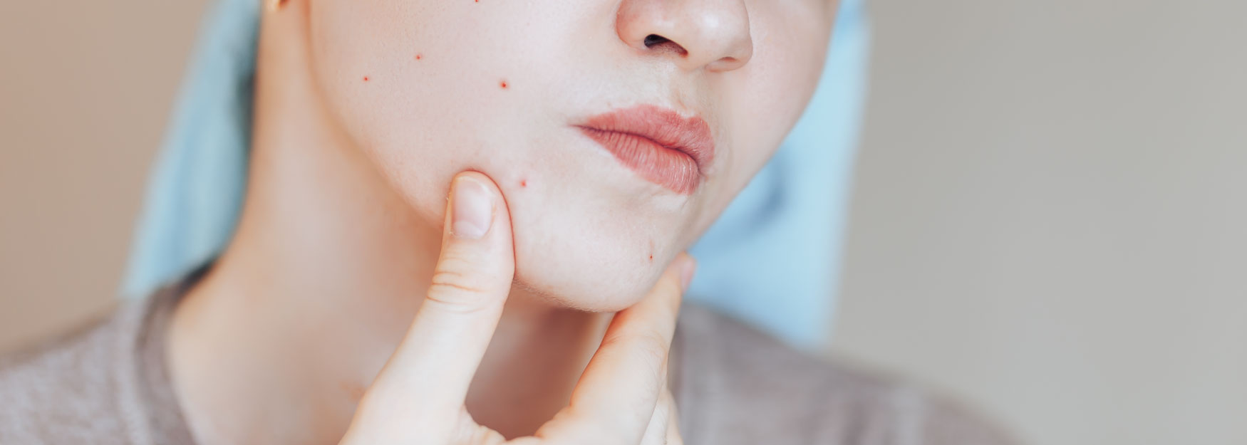 5 Simple Ways To Answer Your Burning Question: How To Get Rid of Acne? Image