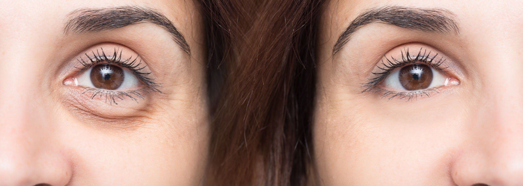 Get Rid Of Those Bags! 4 Ways To Treat Under Eye Circles Image