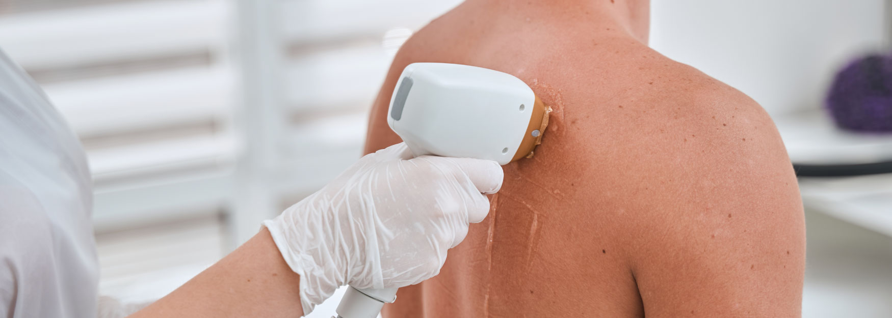 Back Hair Laser Removal : Is It Worth It? Image