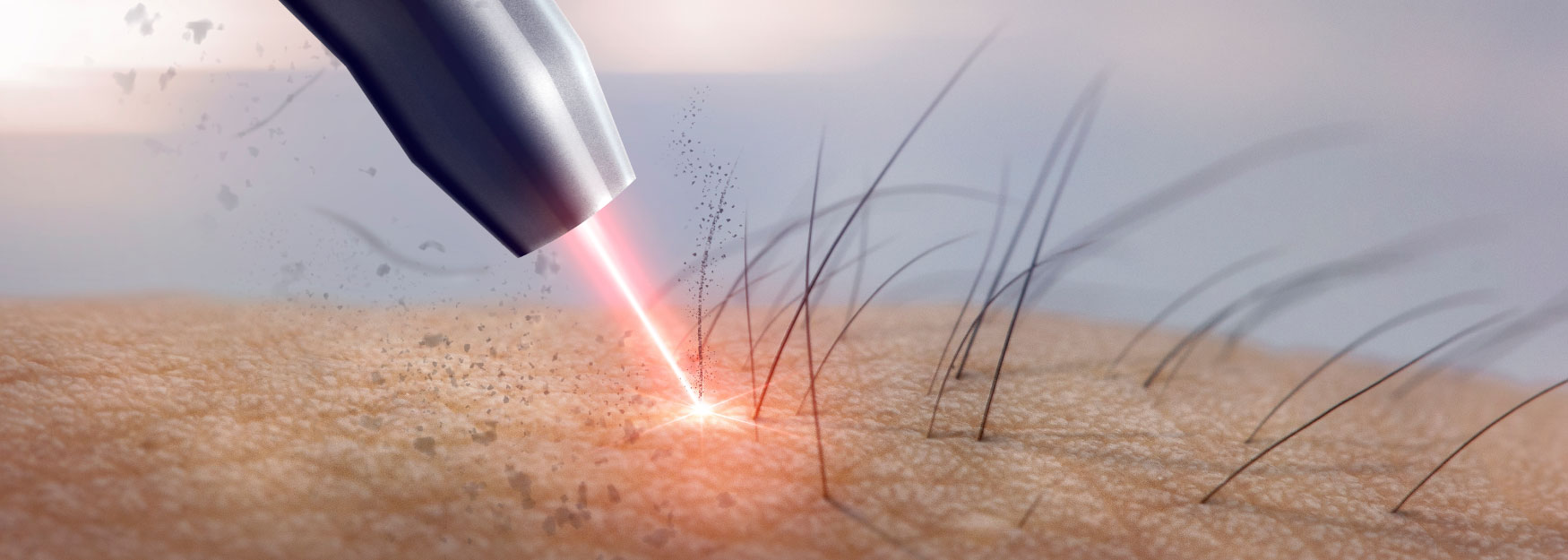 Using Laser Hair Removal Benefits To Achieve Permanent Results Image