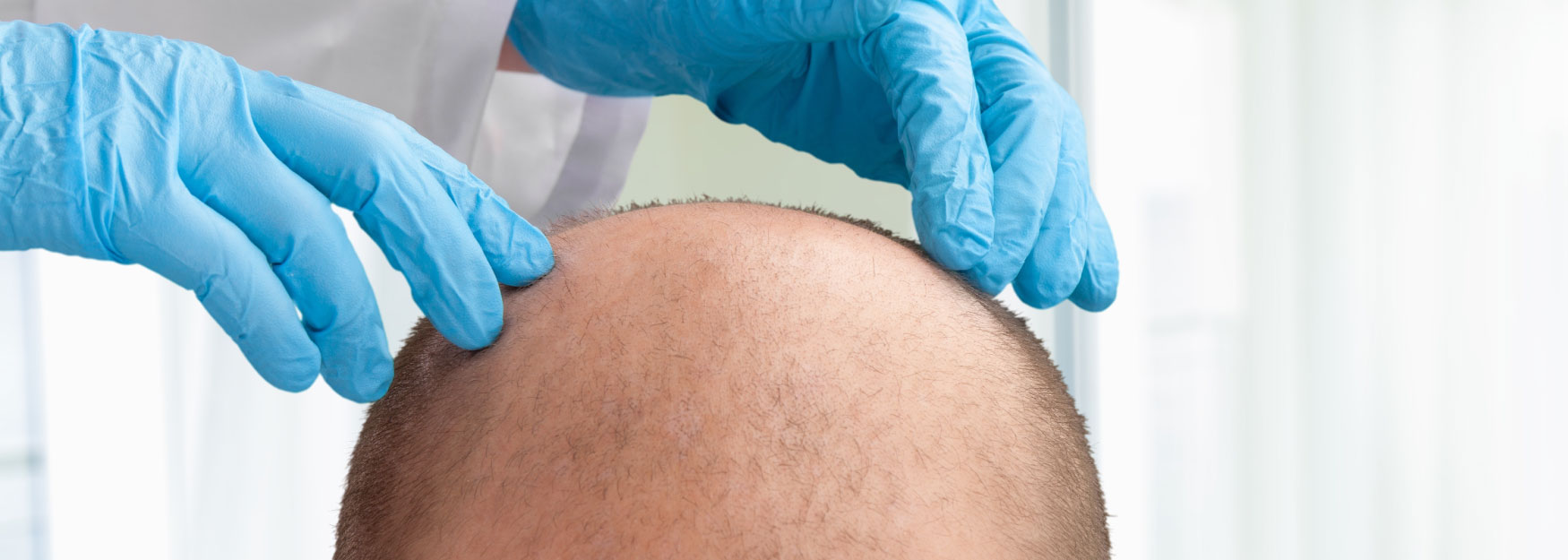 Neograft: The Latest In Hair Treatment Technology Image