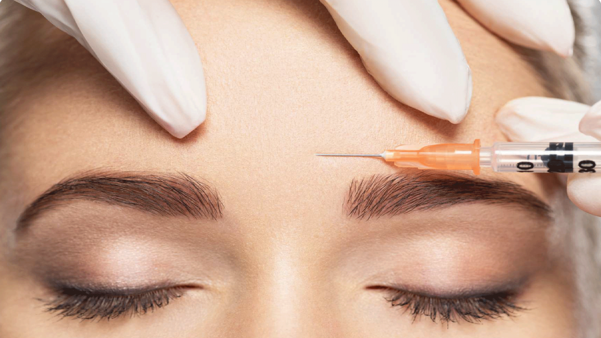 When to Start Botox Image