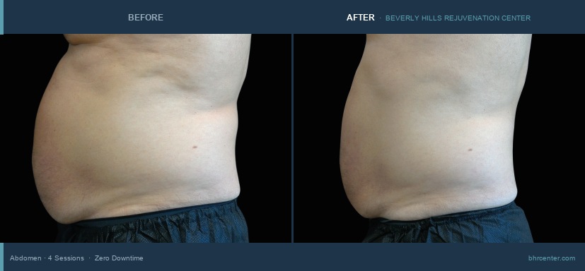 Abdomen — Male · 4 Sessions