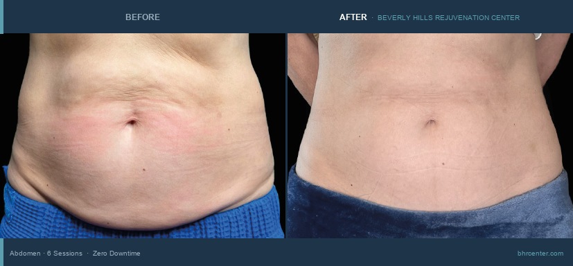 Abdomen — Female · 6 Sessions