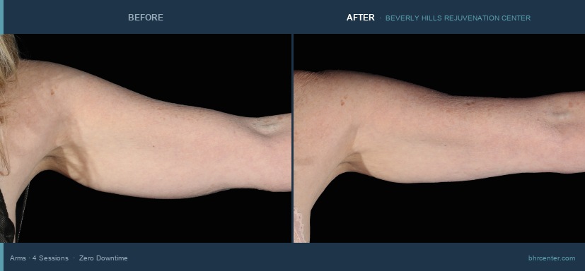 Arms — Female · 4 Sessions