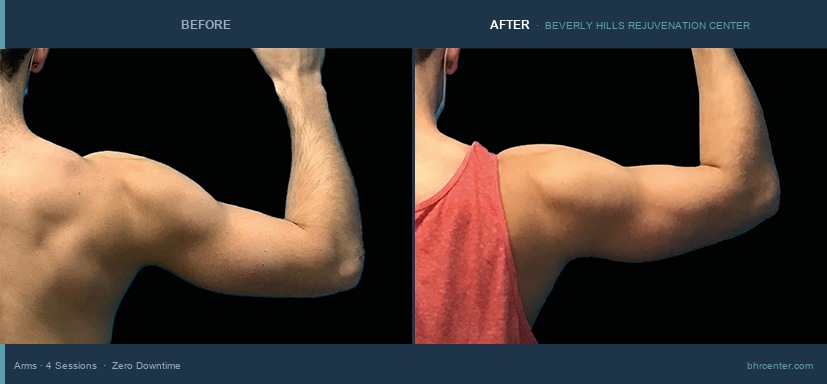 Arms — Male · 4 Sessions