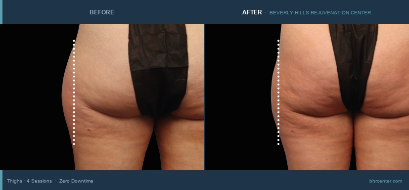 Outer Thighs · 4 Sessions