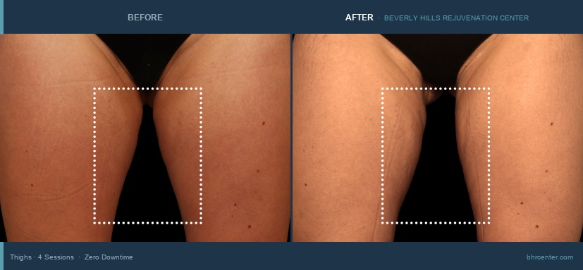 Inner Thighs · 4 Sessions