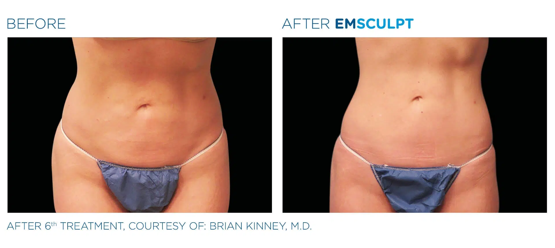 Abdomen — Female · 6 Sessions
