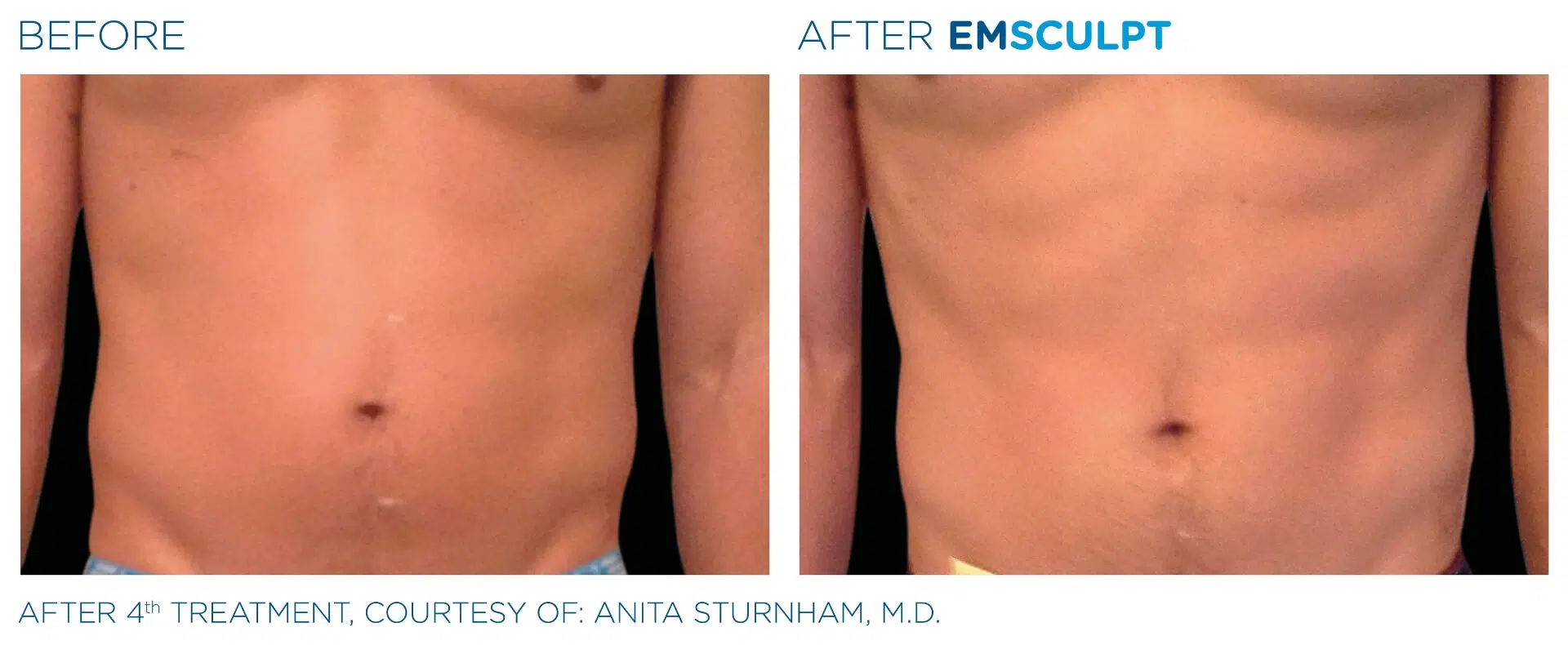 Abdomen — Male · 4 Sessions