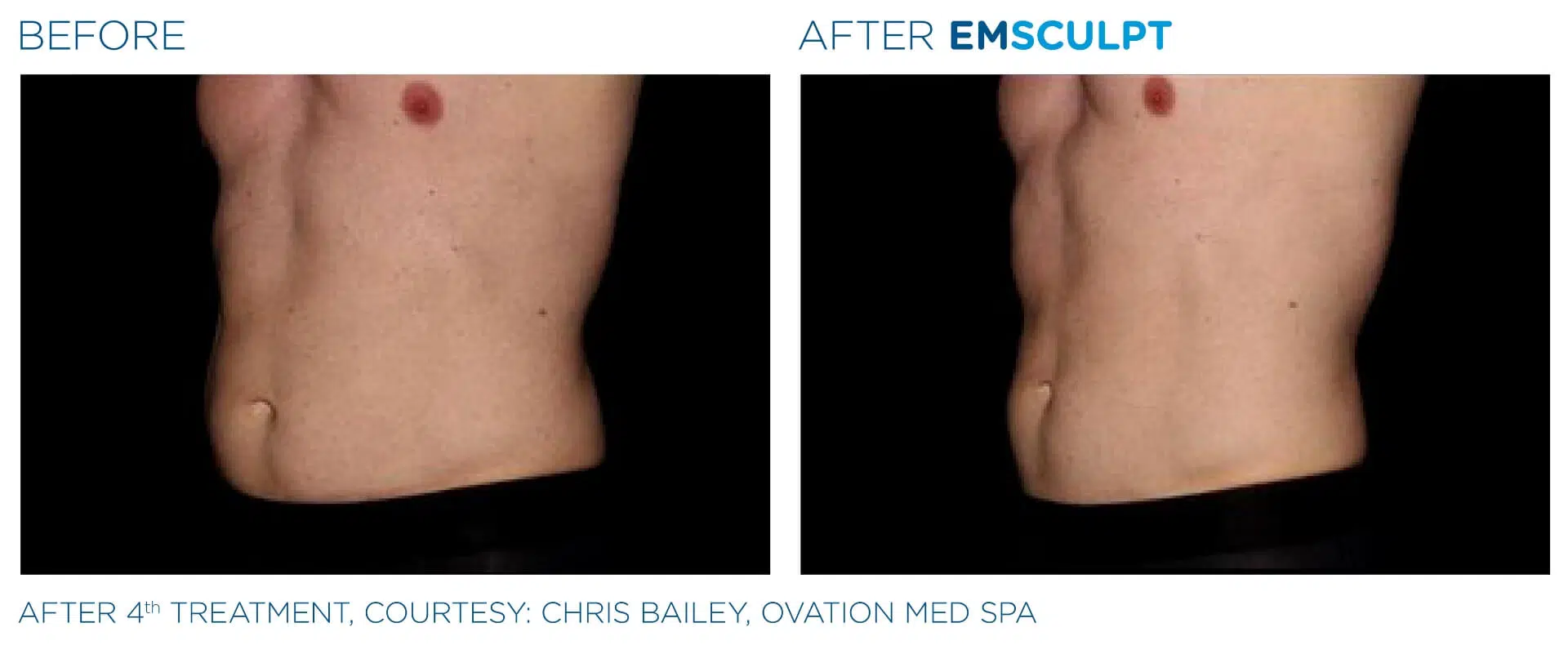 Abdomen Profile — Male · 4 Sessions