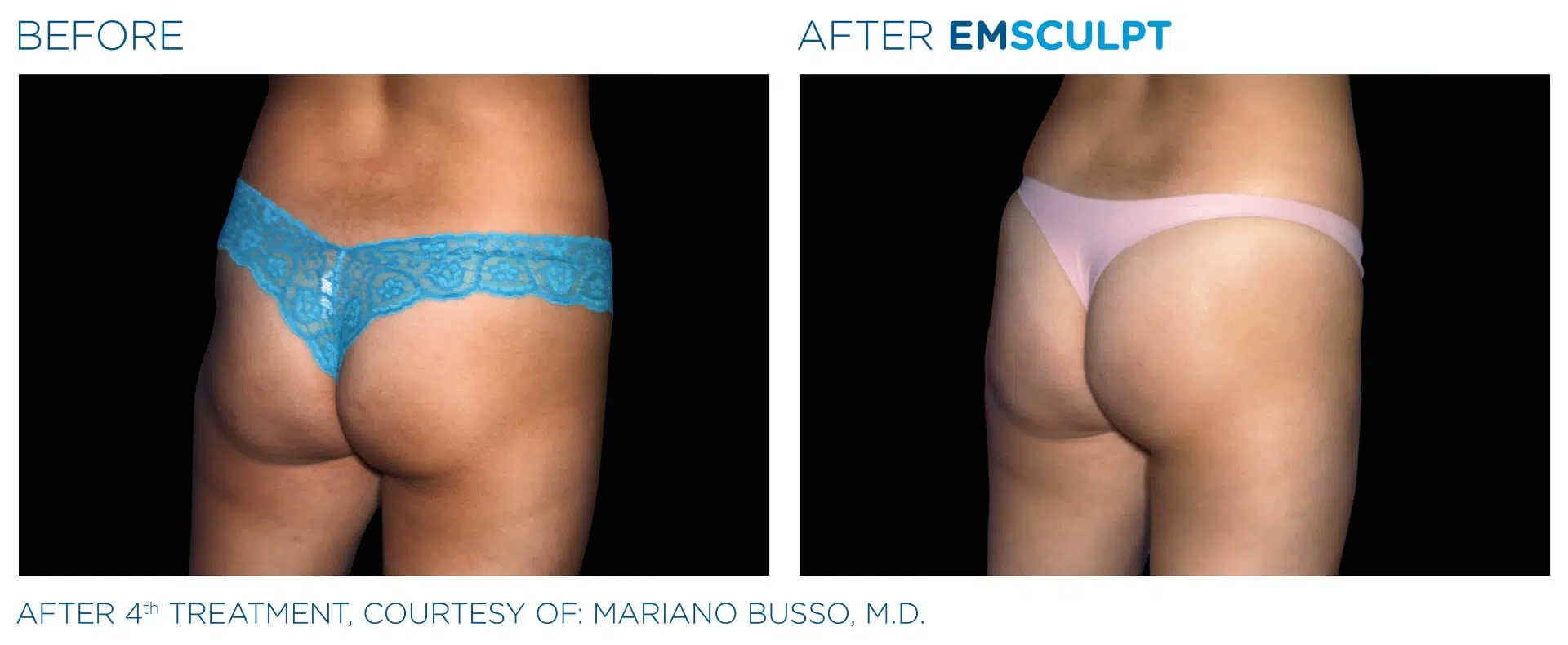 Glutes — Female · 4 Sessions