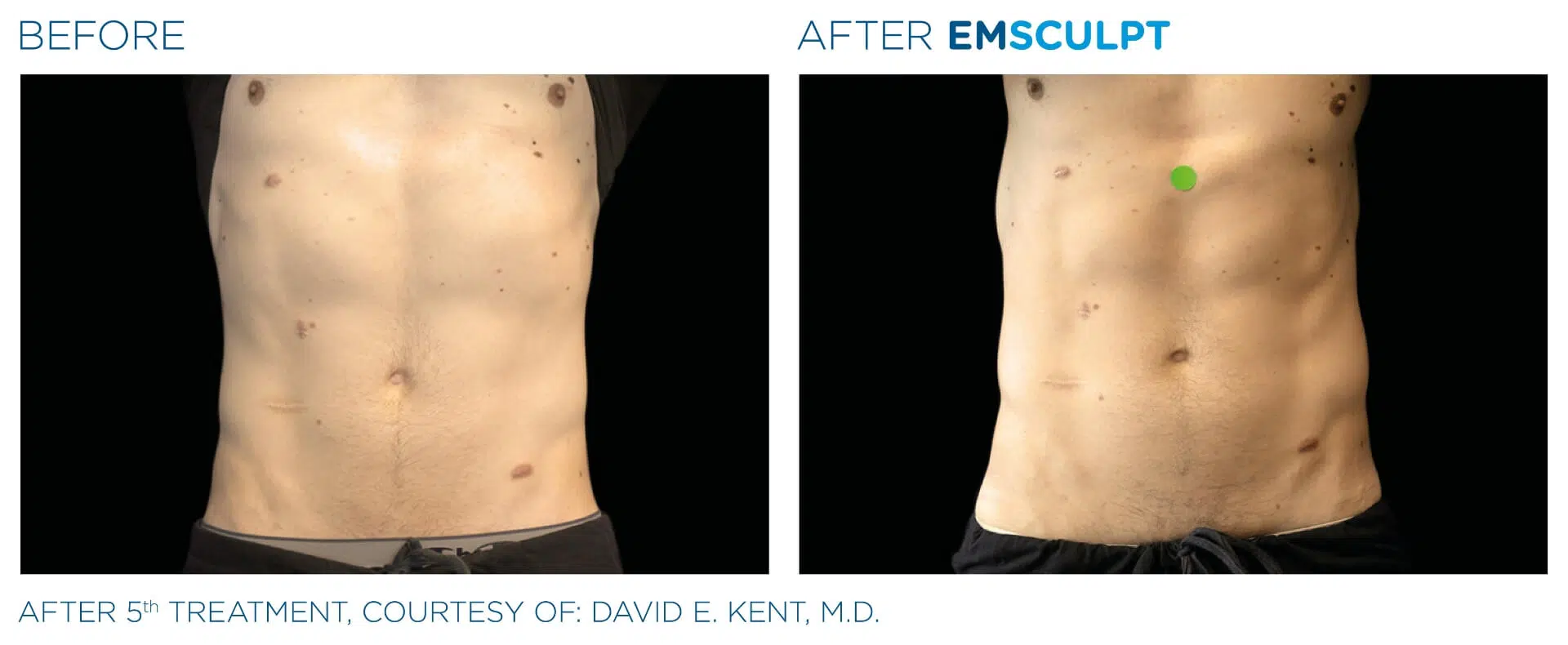 Abdomen — Male · 5 Sessions