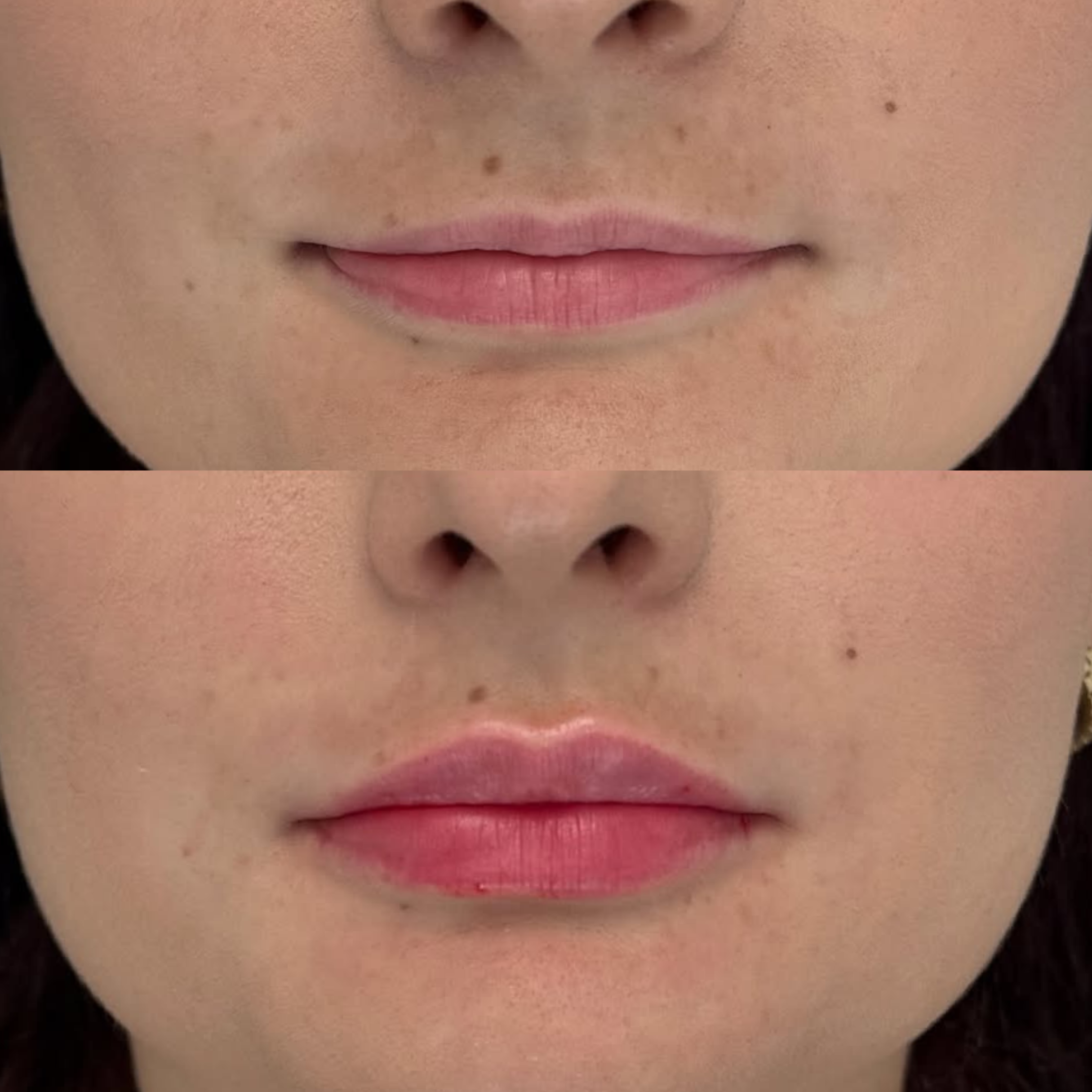Lip filler before and after — even, balanced lip enhancement
