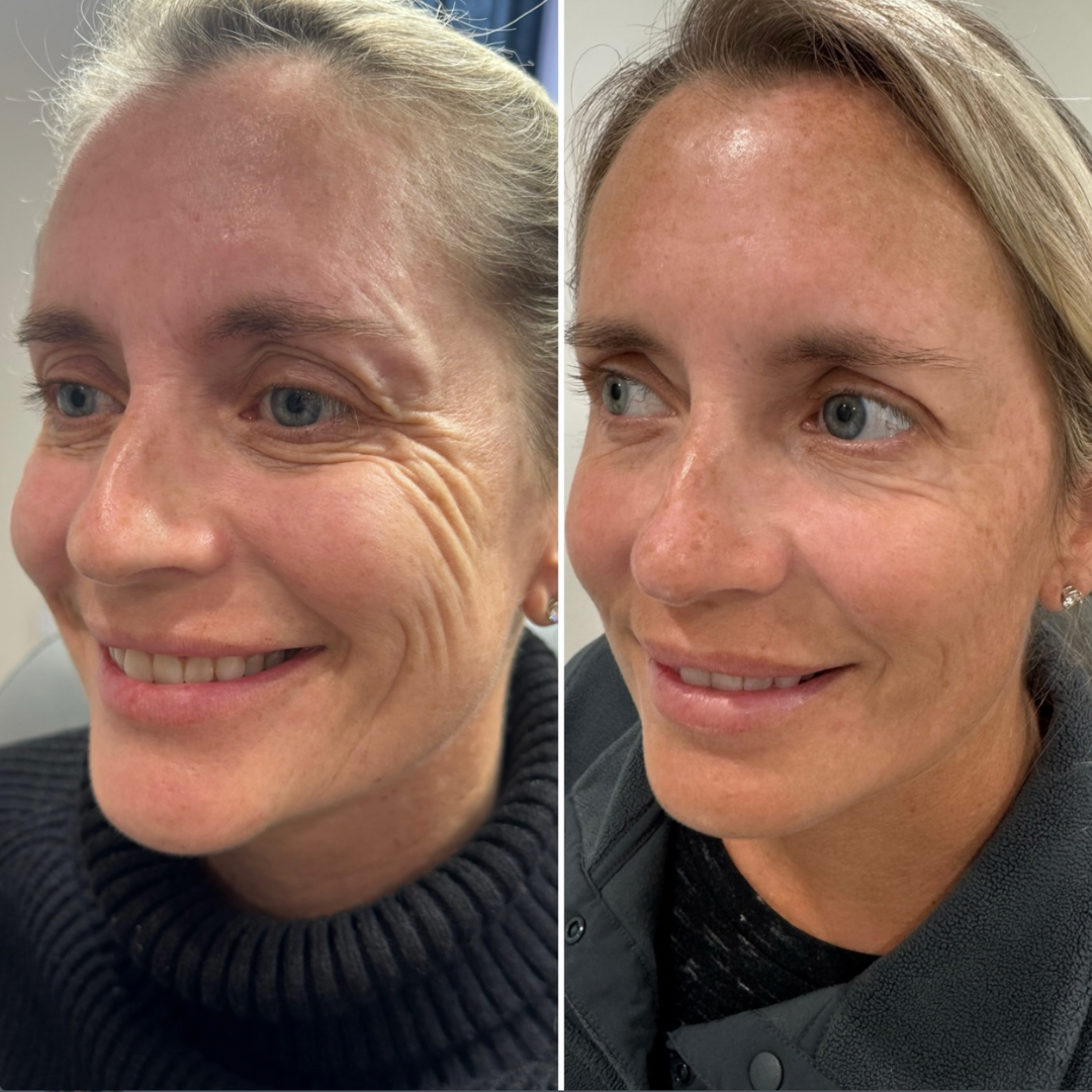 Botox before and after — crow's feet