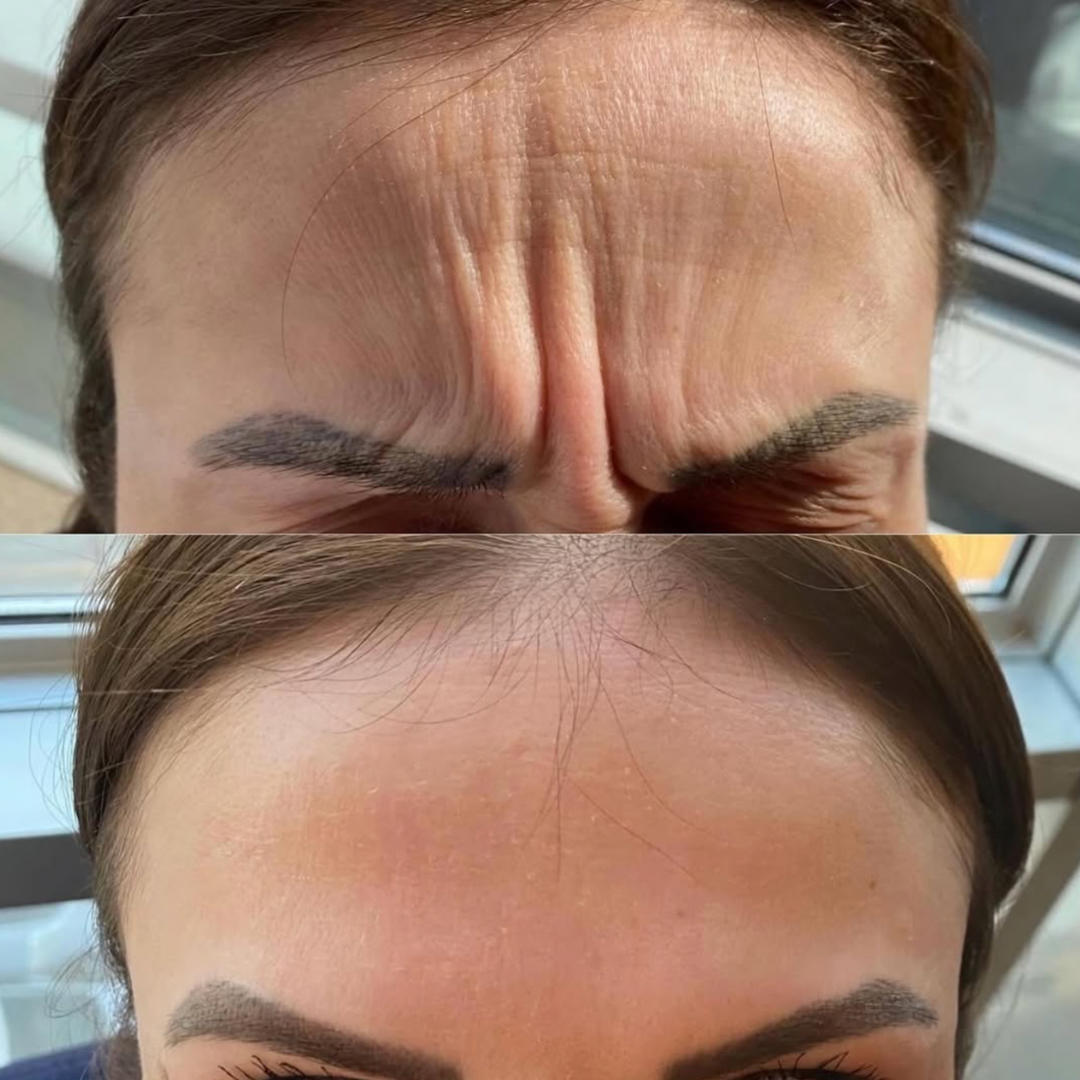 Close-up of smooth forehead after Botox