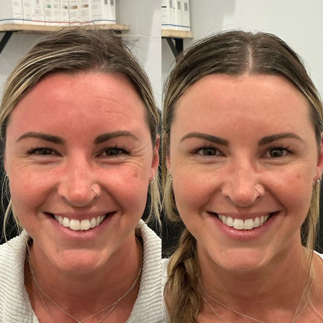 Botox before and after — forehead lines