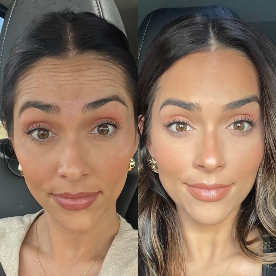 Botox before and after — smooth, refreshed result