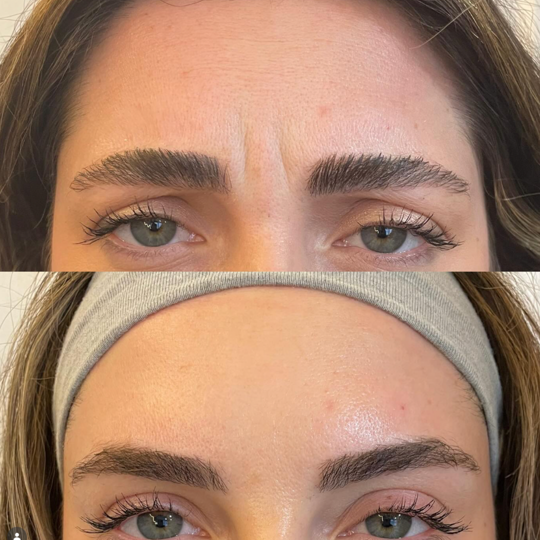 Botox before and after — frown lines between the brows