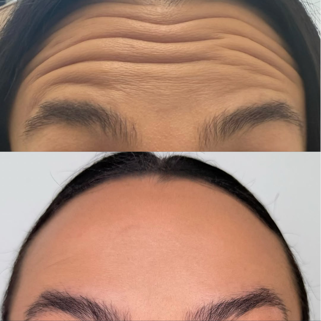 Refreshed, natural forehead result