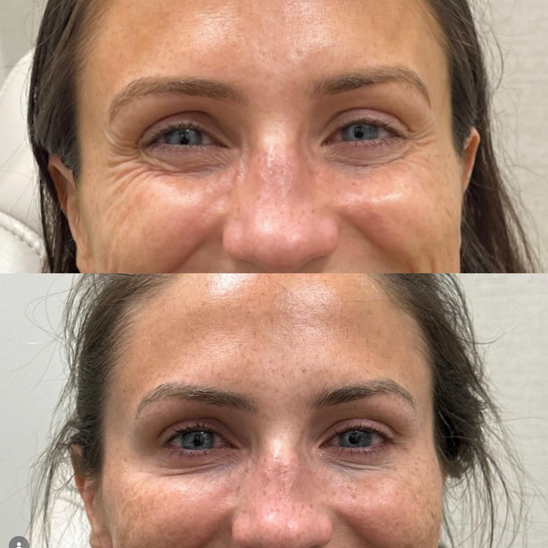 Crow's feet result