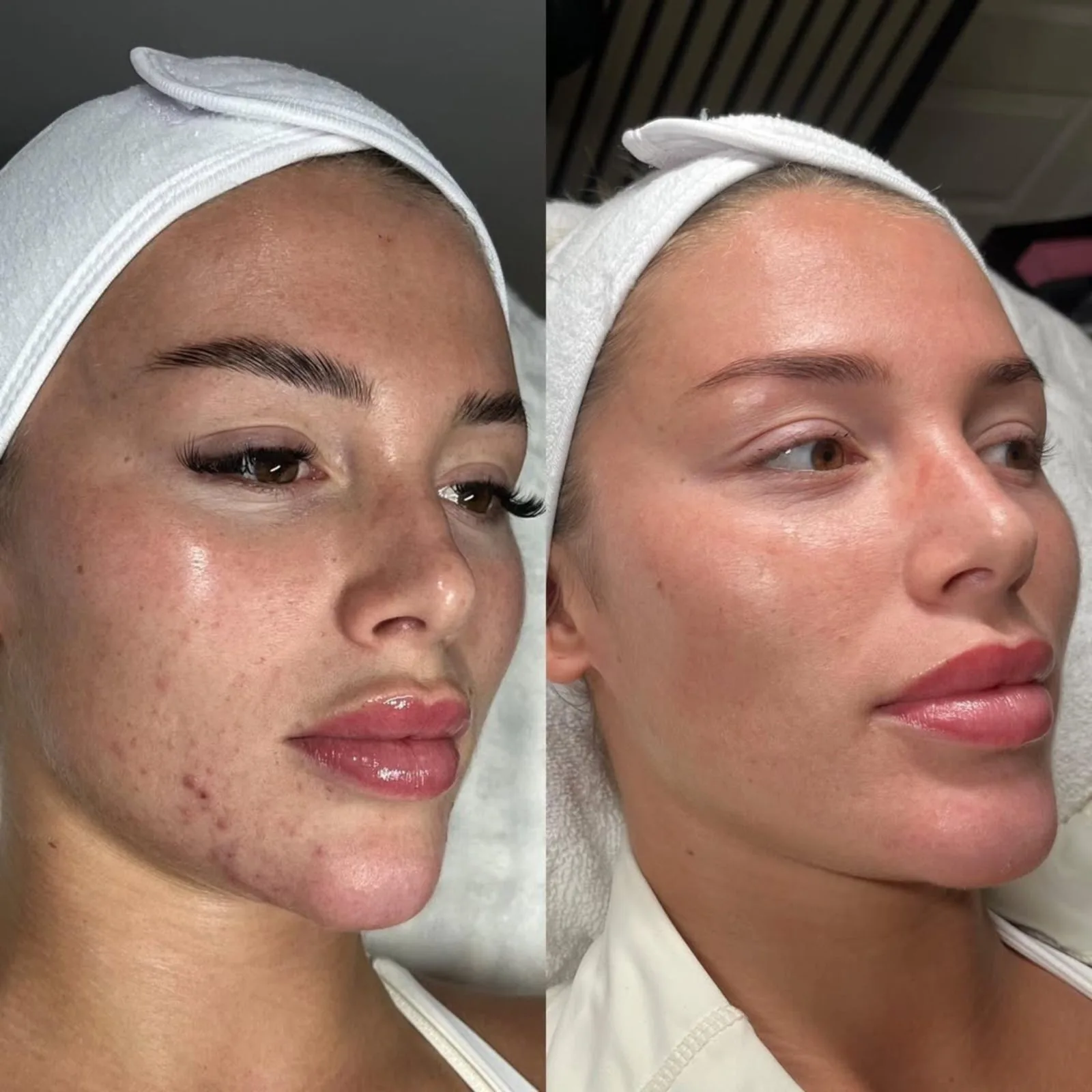 Before and after microneedling at BHRC