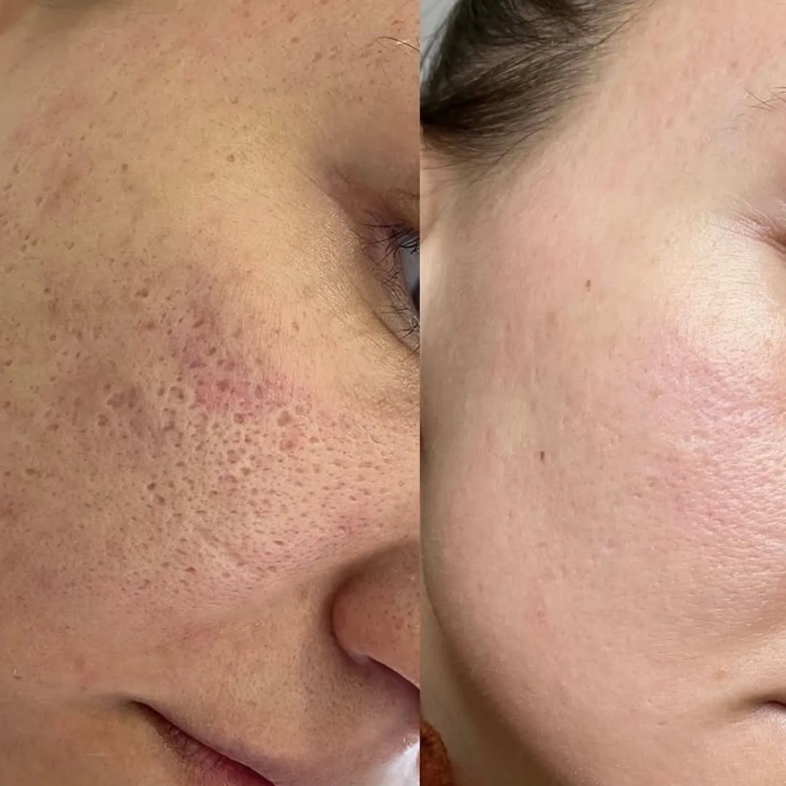 Before and after microneedling for acne scarring and enlarged pores at BHRC