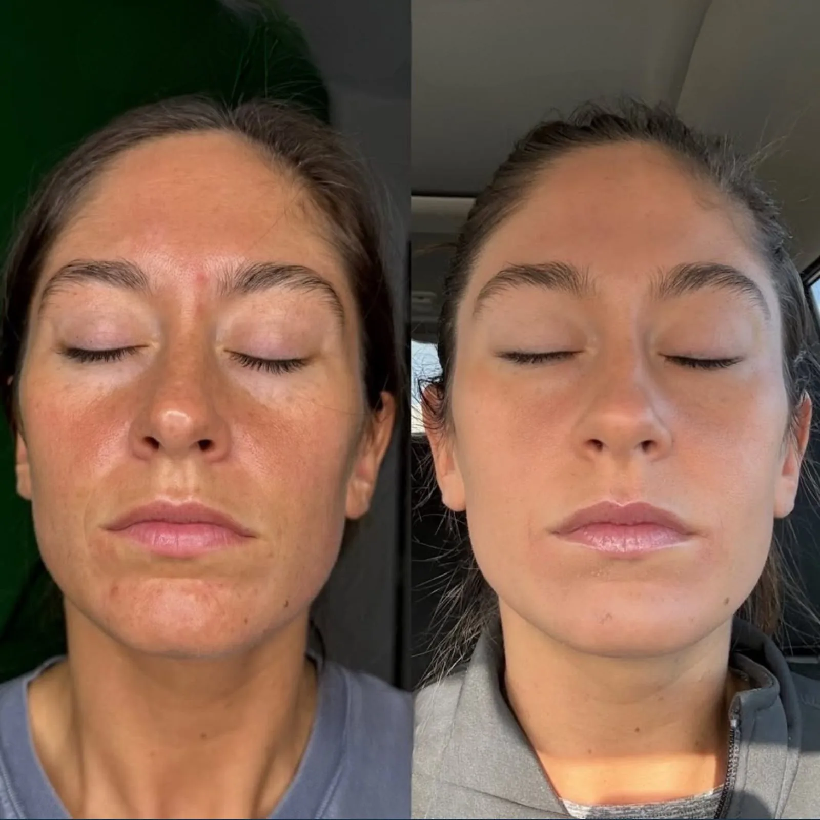Before and after microneedling on the face at BHRC