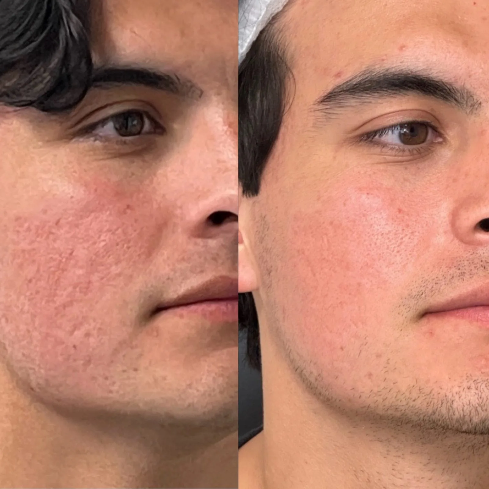 Before and after microneedling for skin texture at BHRC