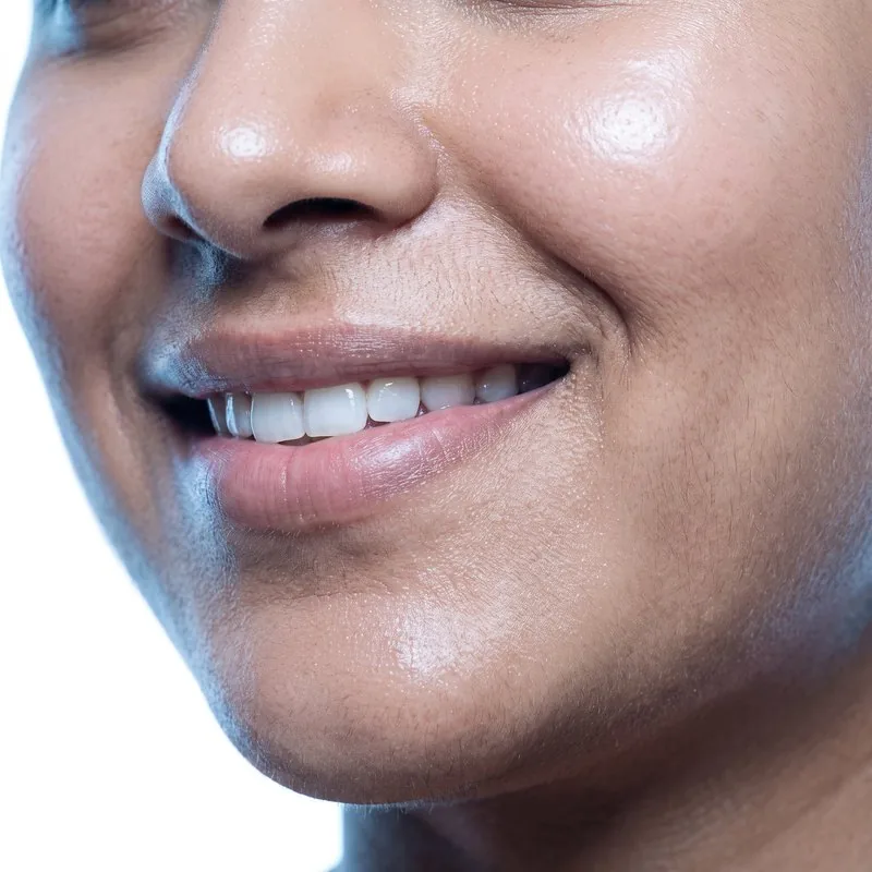 Close-up of lips after a lip flip at BHRC