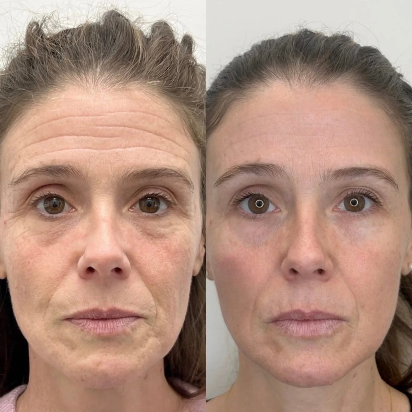 Before and after CO2 laser resurfacing for aging skin at BHRC