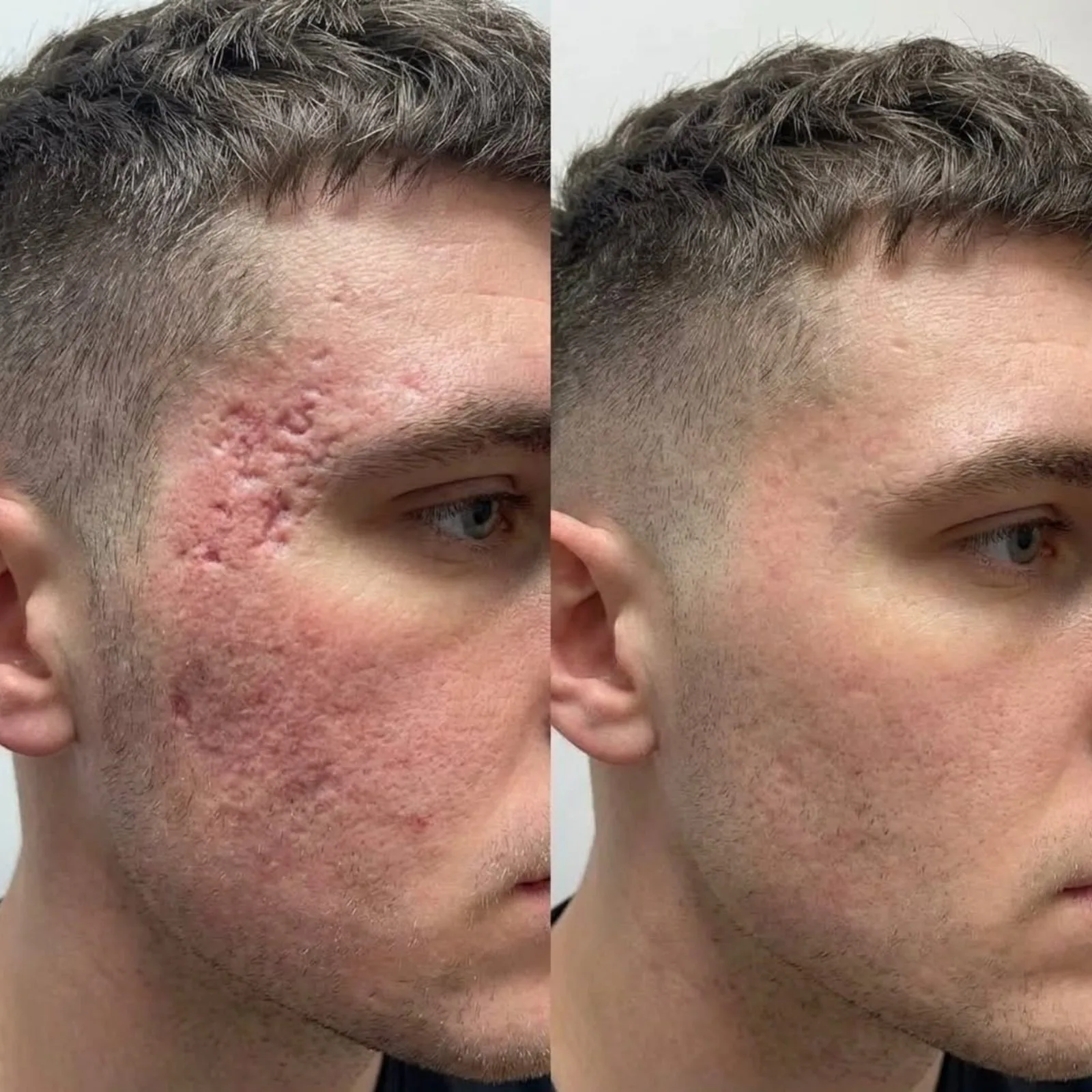 Before and after CO2 laser resurfacing for acne scarring at BHRC