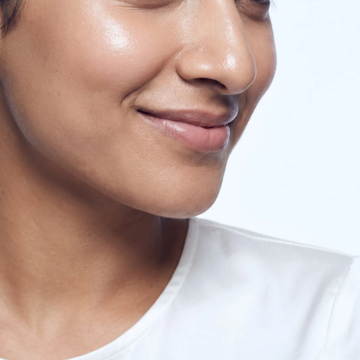 Nasolabial fold filler at BHRC